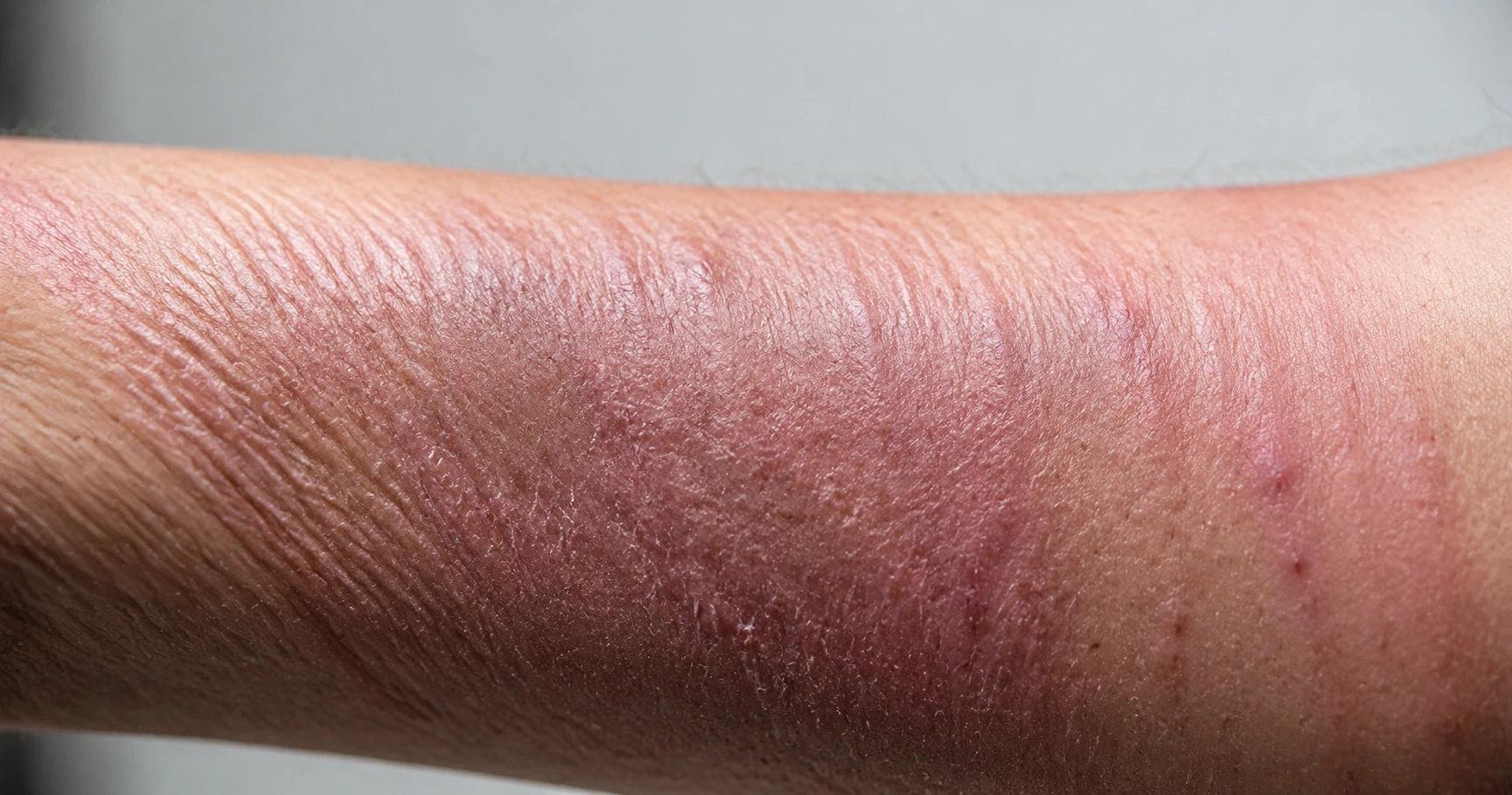 Hình ảnh soi da bị nhiễm corticoid: Nhận diện và hiểu rõ tác hại - image 2